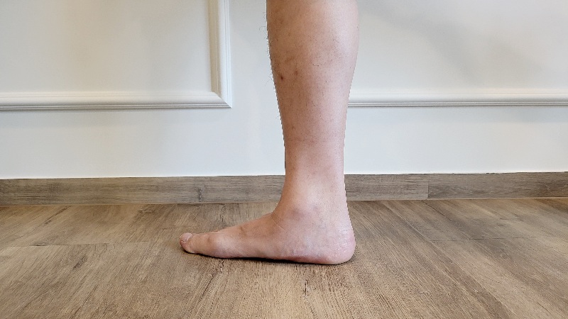 Flat Feet