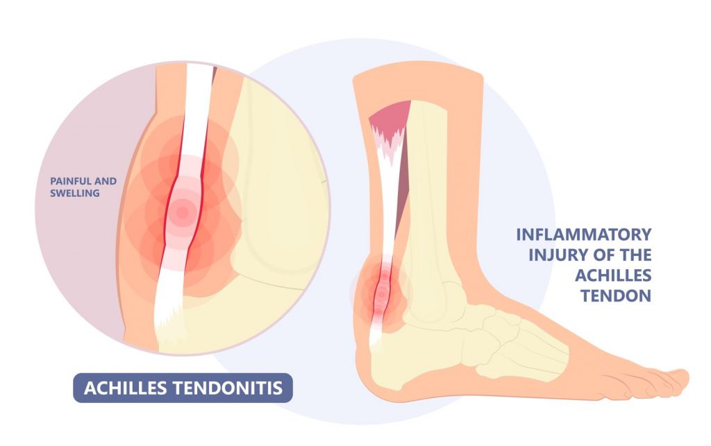 Achilles tendonitis treatment in SIngapore. A photo showing the anatomy of the achilles tendon and where the tendon is inflamed. Straits Podiatry in Singapore.