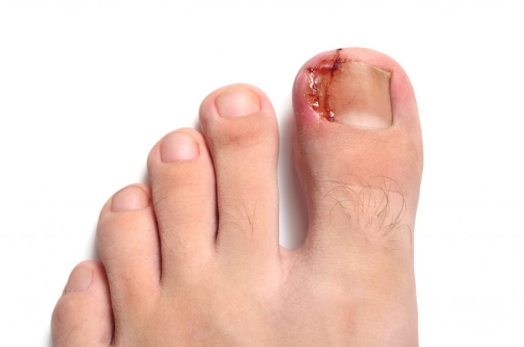 Ingrown Toenail Treatment in Singapore. How to treat ingrown toenails? Straits Podiatry