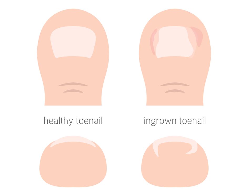 What is ingrown toenail? Ingrown Toenail in Singapore - Straits Podiatry
