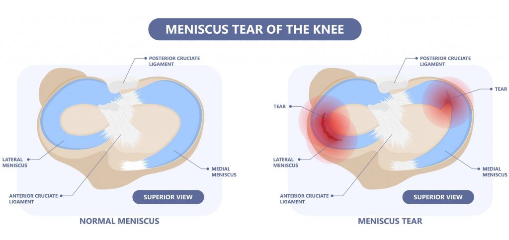 What is meniscus tear? Straits Podiatry Singapore