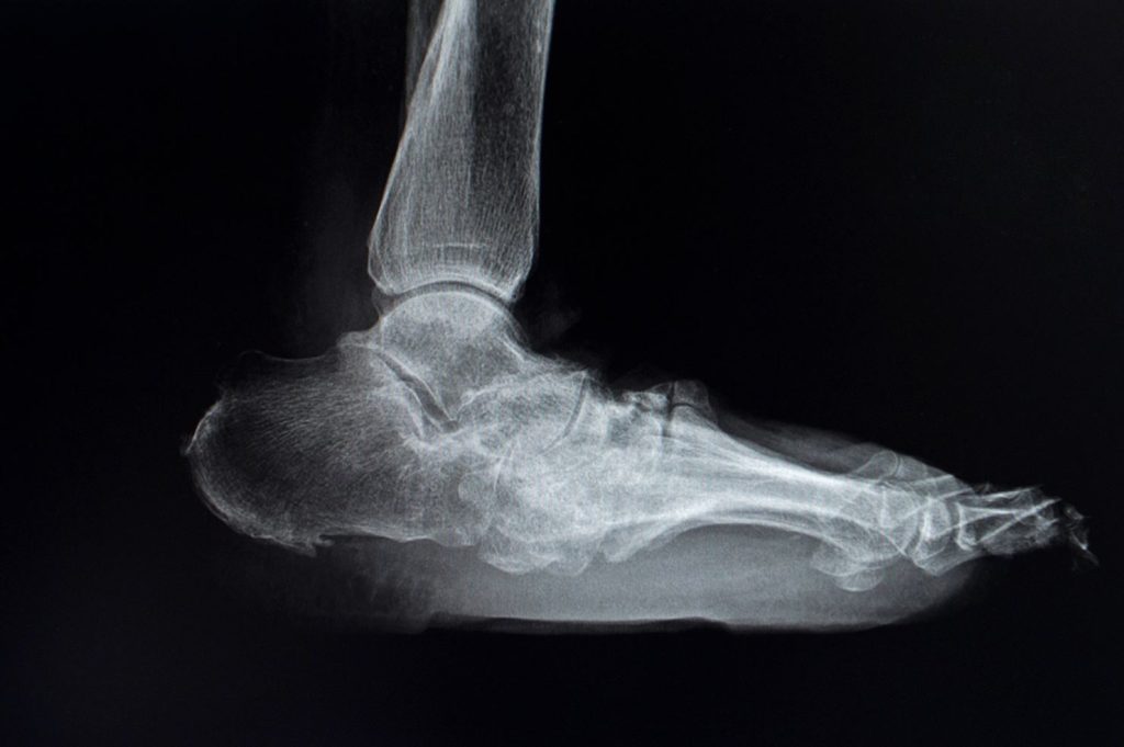 Diabetic Charcot Foot X-ray