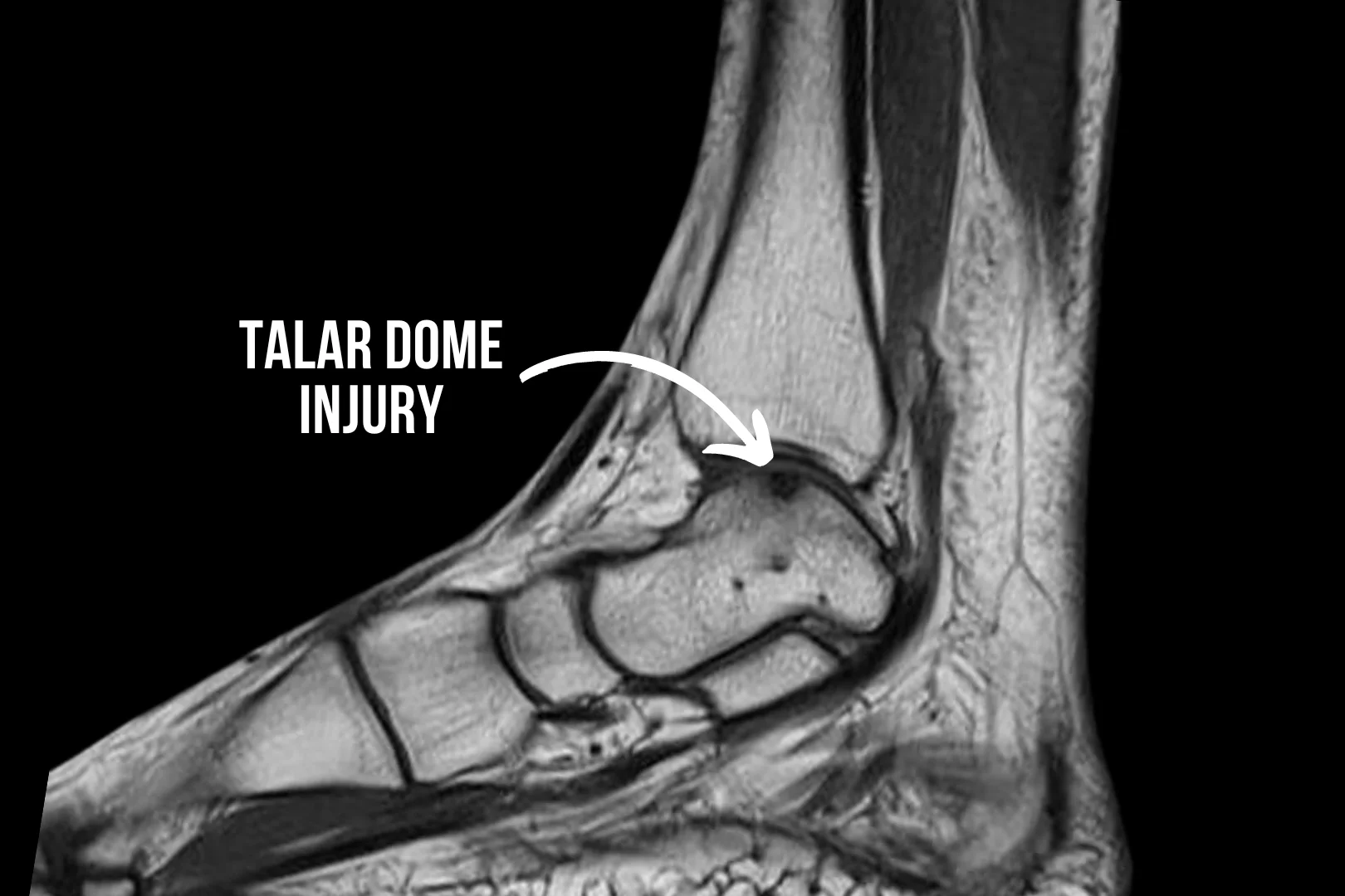 Talar dome injuries