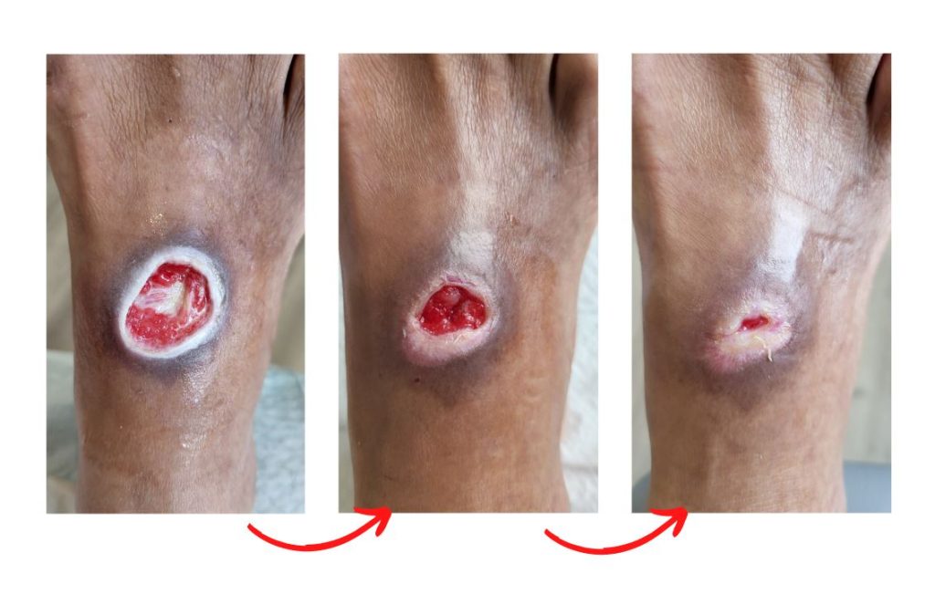 Diabetic foot ulcer and wounds treatment in Singapore.