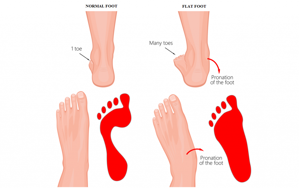 What is flat feet? How to tell if I have flat feet? Straits Podiatry