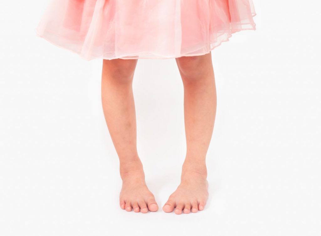 What is In-Toe Walking? What is Pigeon toed walking? Straits Podiatry