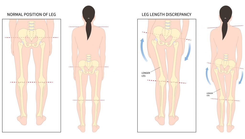 What is Leg Length Discrepancy? Straits Podiatry