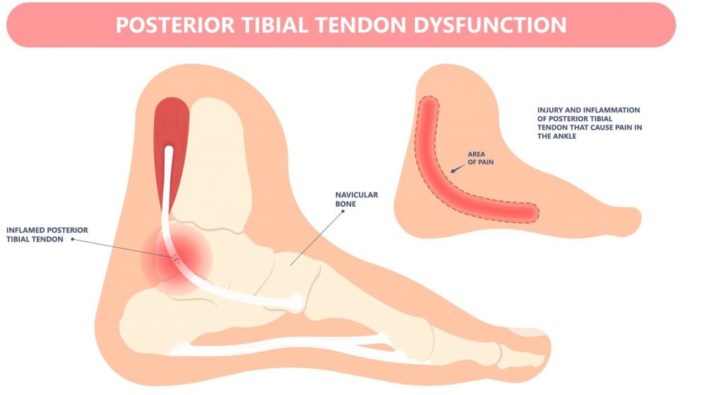 What is posterior tibial tendon dysfunction? What is posterior tibial tendinitis? Straits Podiatry