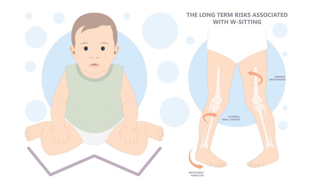 What are the causes of in-toe walking? Risk factors of pigeon toe. Straits Podiatry