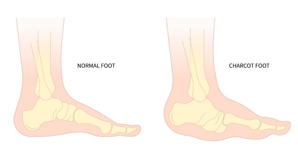Charcot Foot or Charcot Neuroarthropathy in Singapore