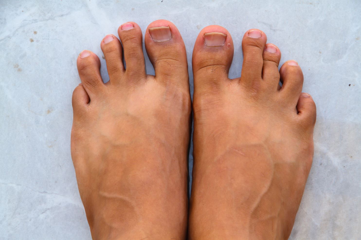 How to Alleviate Pain and Discomfort from Curly Toe Syndrome in Singapore?